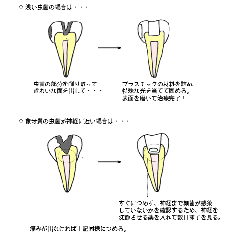 軽度の虫歯の治療方法